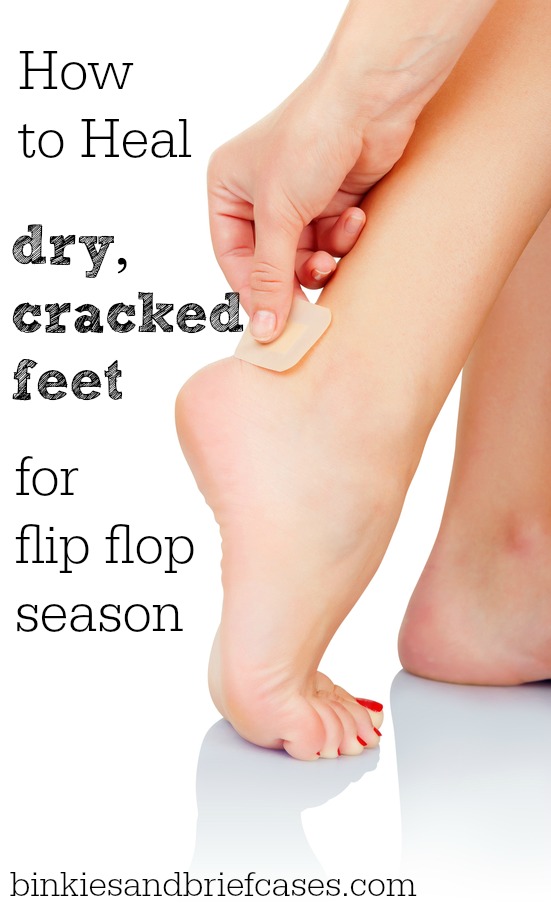tips for how to heal dry and cracked feet 