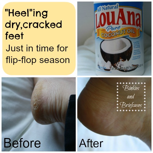 How to heal dry, cracked feet