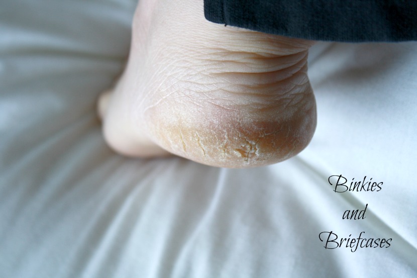 healing dry feet